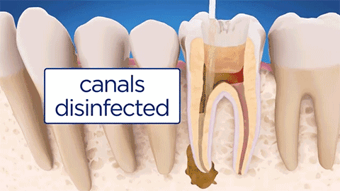Root canal flushing and disinfection