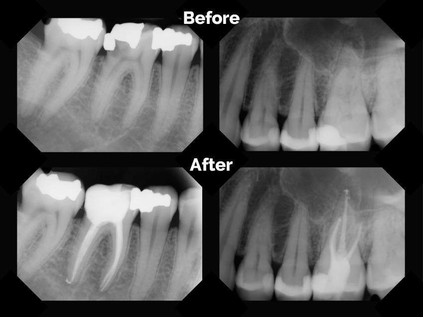 Root Canal Before And After