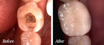 Root Canal Before And After
