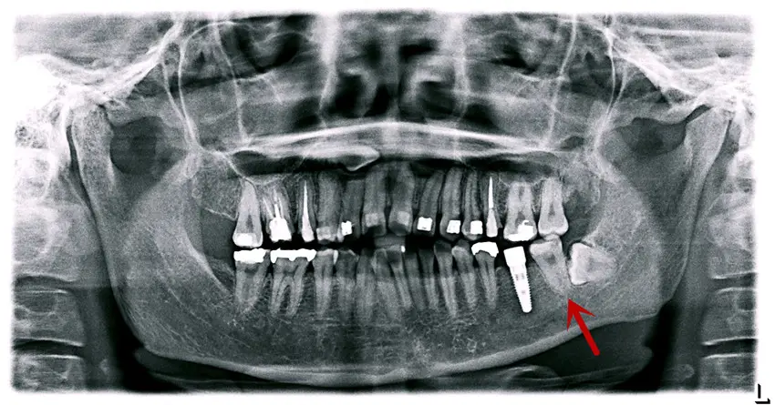Root Canal X-ray
