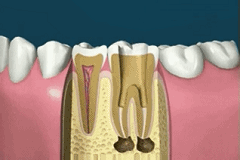 Root canal piling