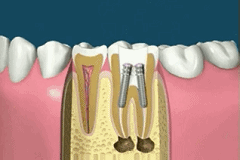 Complete dental restoration